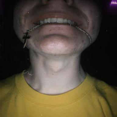 NR
